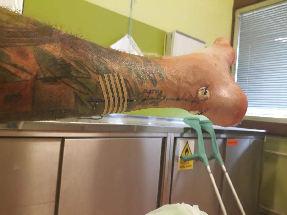 Přetržená Achillova šlacha aneb jak může být během sekundy všechno jinak (díl 1/3)