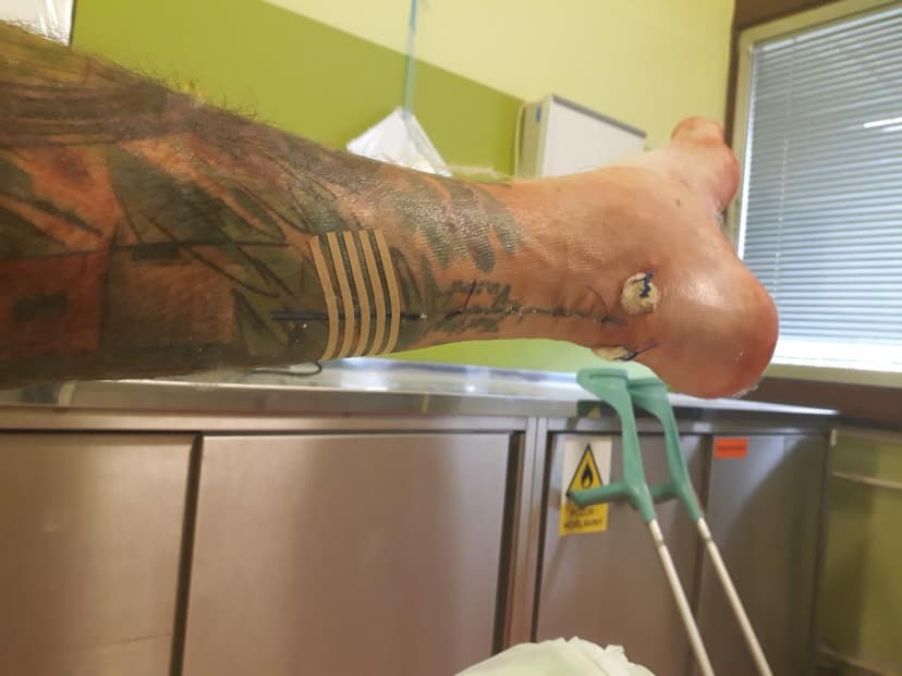 Přetržená Achillova šlacha aneb jak může být během sekundy všechno jinak (díl 1/3)
